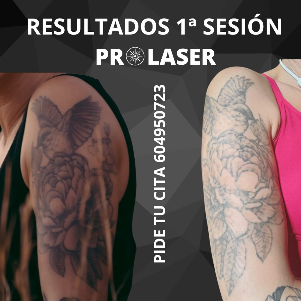 ejemplo de quitar tatuajes pro laser quitar tatuajes almeria
